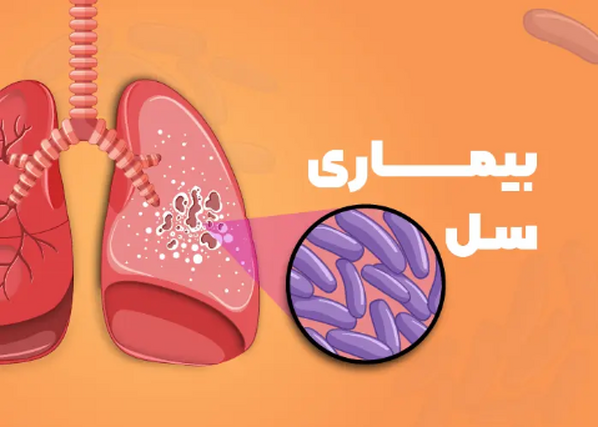 یاداشتی از دکتر حسین شهزادی بمناسبت روز جهانی بیماری سل / بله ما می توانیم به بیماری سل پایان دهیم
