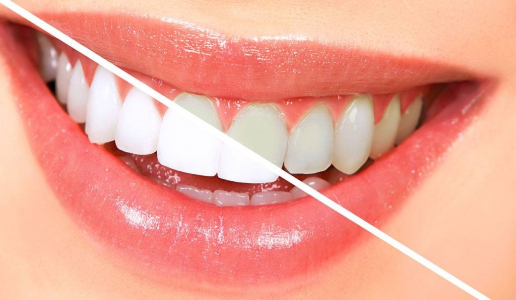 سفید کردن دندان با راه حل دائمی