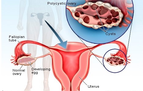 آیا کیست تخمدان خطرناک است؟ همه چیز در مورد کیست تخمدان (علل، علائم، پیشگری و راه های درمان)