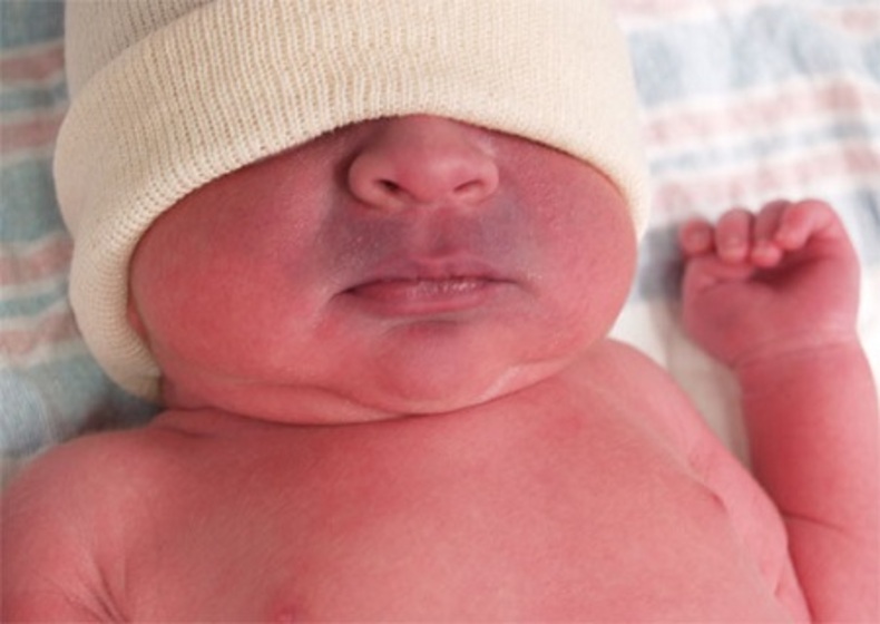 سیانوز در نوزادان چیست؟ عوامل و درمان سیانوز