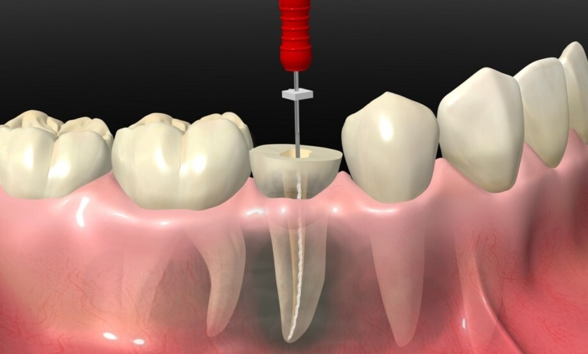 عصب کشی دندان چگونه انجام می‌گیرد؟ + فیلم