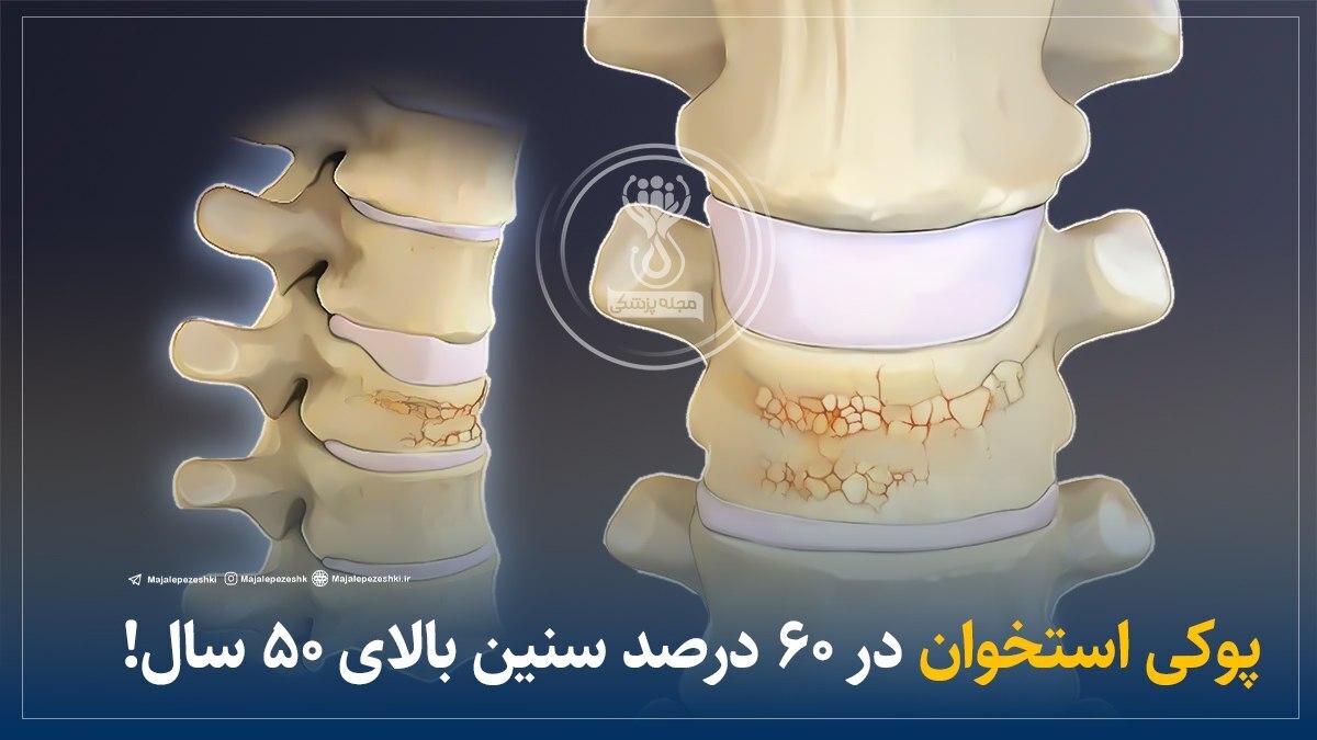 پوکی استخوان در ۶۰ درصد سنین بالای ۵۰ سال!