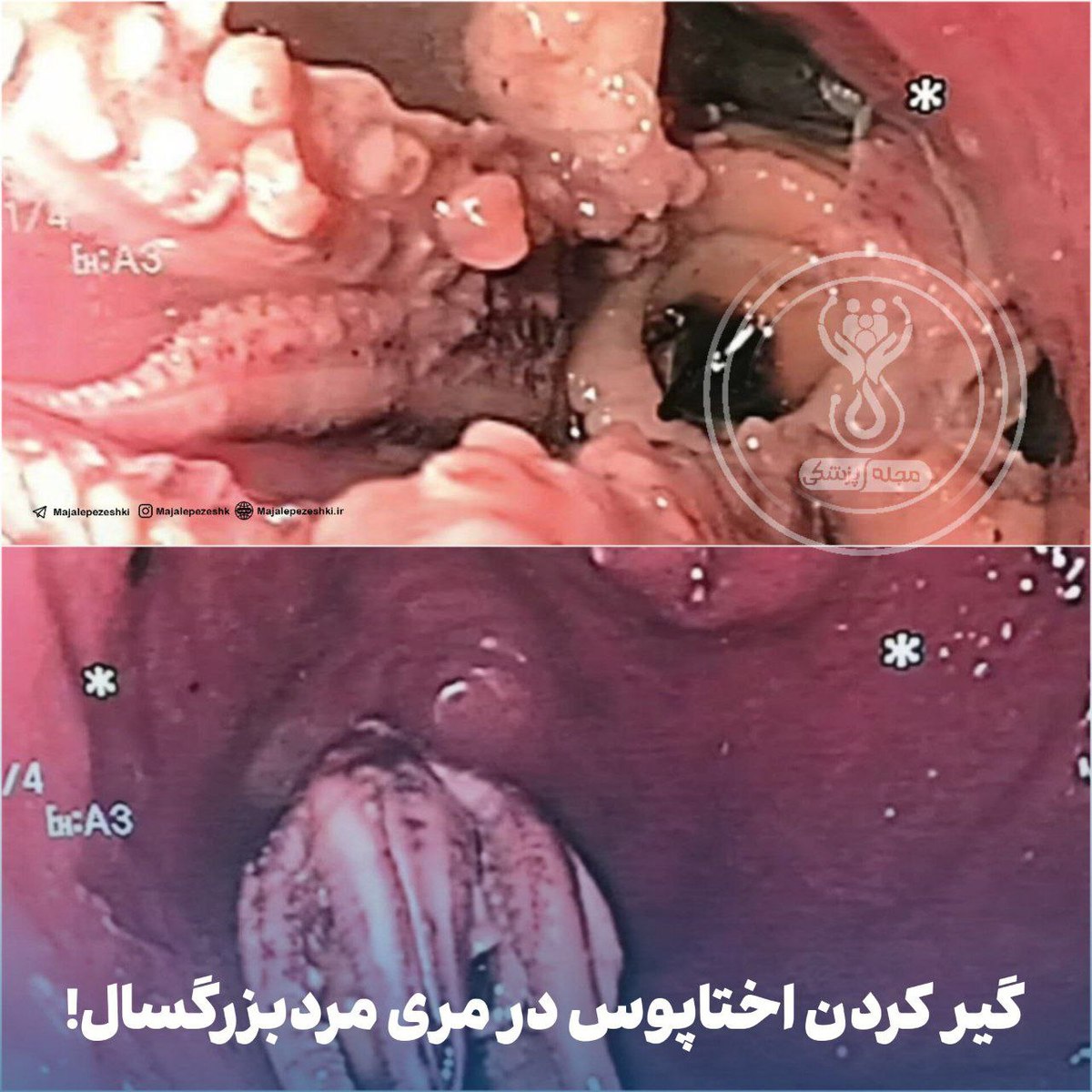 در سنگاپور، پزشکان یک اختاپوس کامل را از بیمار مبتلا به معده درد خارج کردند !