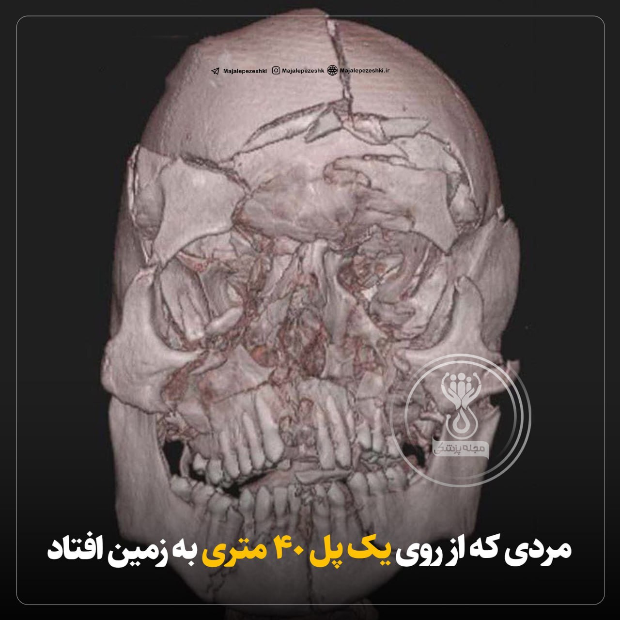 توموگرافی کامپیوتری جمجمه، پس از مرگ!