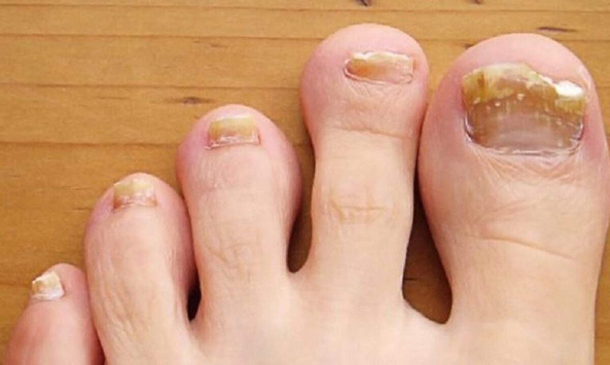 پیشگیری و درمان ضخیم شدن ناخن های پا