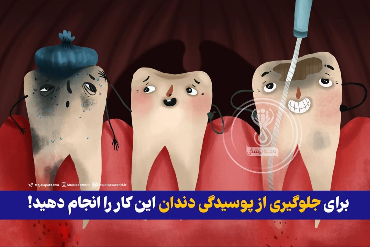 برای جلوگیری از پوسیدگی دندان این کار را انجام دهید!