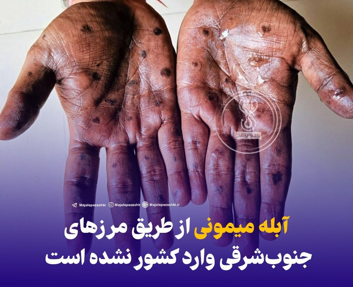 آبله میمونی از طریق مرزهای جنوب‌شرقی وارد کشور نشده است!