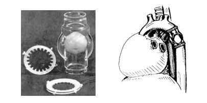 هفتاد و دومين سالروز اولين عمل جراحي تعبيه دريچه مصنوعي قلب در جهان