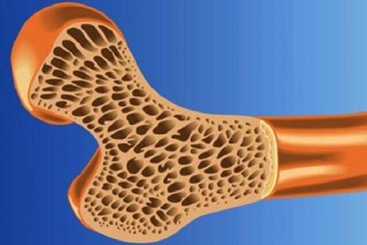 پوکی استخوان در نیمی از جمعیت کشور 